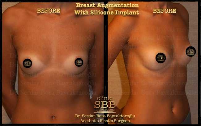 breast augmentation before after 1