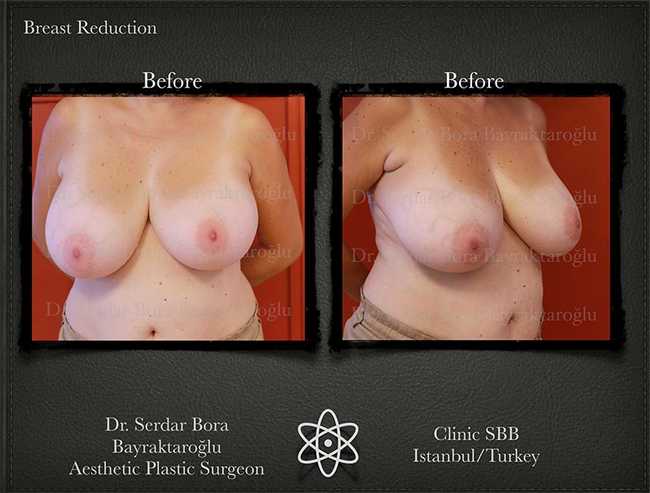 Breast Reduction Before After Serdar Bora Bayraktaroglu In Istanbul Clinic 5