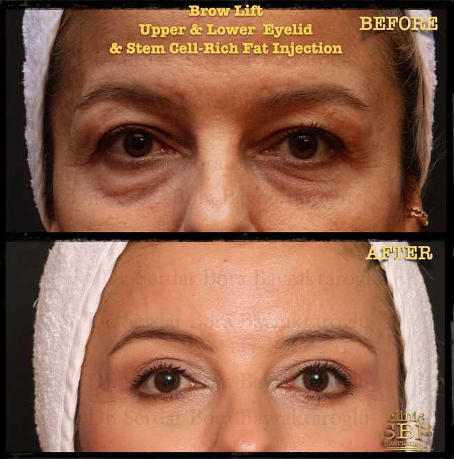upper lower eye lid before after 7