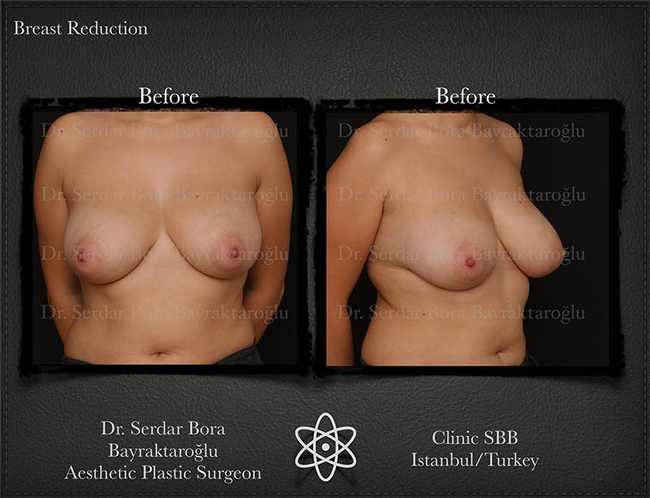 Breast Reduction Before After Serdar Bora Bayraktaroglu In Istanbul Clinic 9