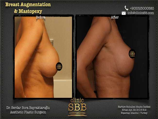 Breast Augmentation Mastopexy Clinic SBB Serdar Bora Bayraktaroglu 4