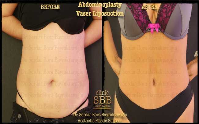 abdominoplasty before after 7