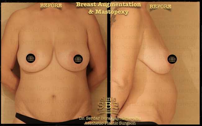 breast augmentation mastopexy before after 10