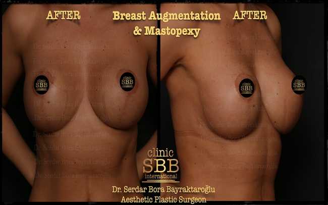 breast augmentation mastopexy before after 9