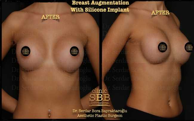 breast augmentation before after 3