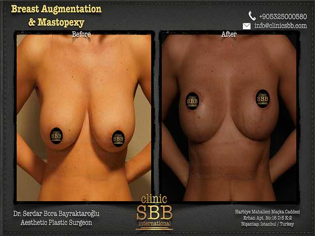 Breast Augmentation Mastopexy Clinic SBB Serdar Bora Bayraktaroglu 2