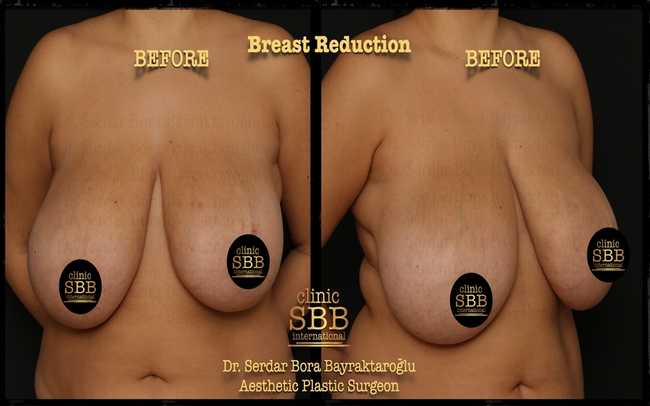 breast reduction before after 8