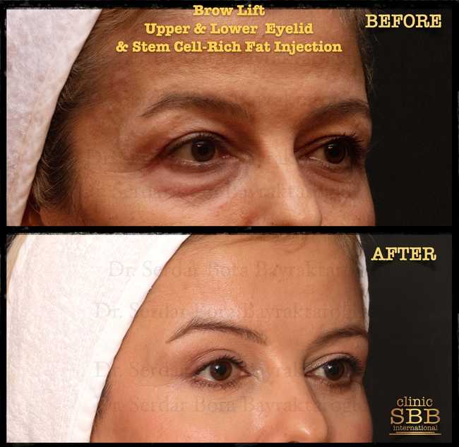 eyebrown lift before after 3