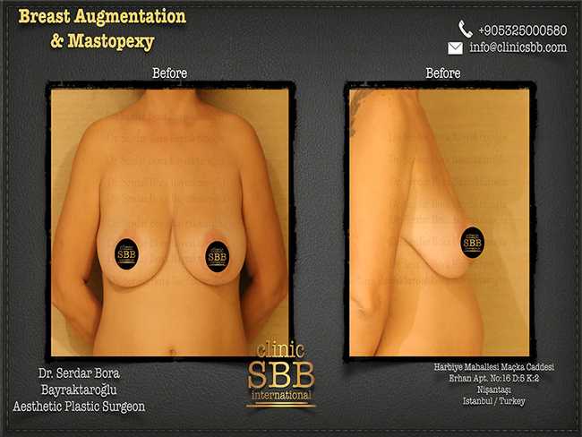 Breast Augmentation Mastopexy Clinic SBB Serdar Bora Bayraktaroglu 11