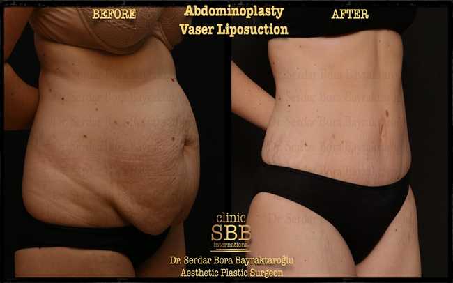 abdominoplasty before after 3