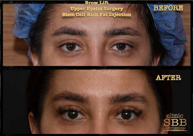 eyebrown lift before after 7