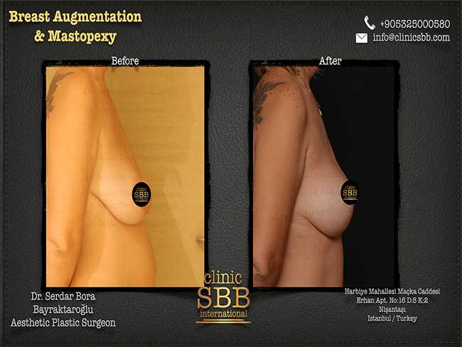 Breast Augmentation Mastopexy Clinic SBB Serdar Bora Bayraktaroglu 14