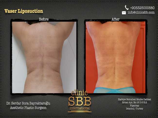 Vaser Liposuction Clinic SBB Serdar Bora Bayraktaroglu 7