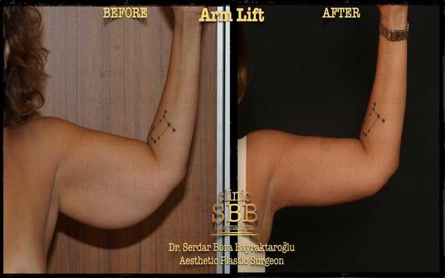 arm leg lift before after 2