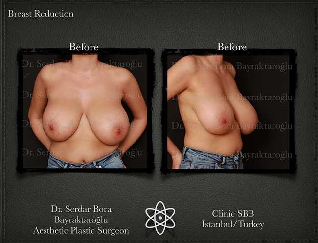 Breast Reduction Before After Serdar Bora Bayraktaroglu In Istanbul Clinic 1
