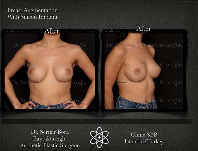 Breast Augmentation Before After Serdar Bora Bayraktaroglu In Istanbul Clinic 8 1