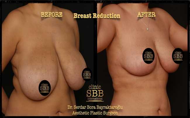 breast reduction before after 7