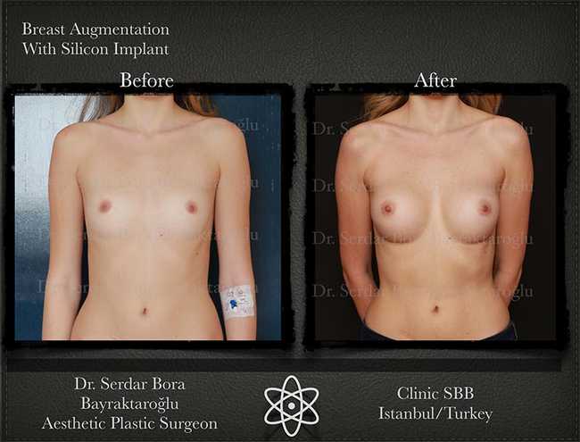 Breast Augmentation Before After Serdar Bora Bayraktaroglu In Istanbul Clinic 2 1