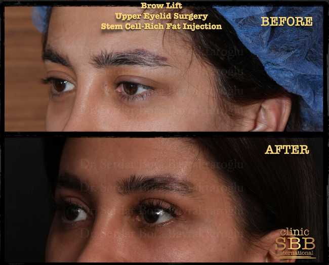 eyebrown lift before after 8