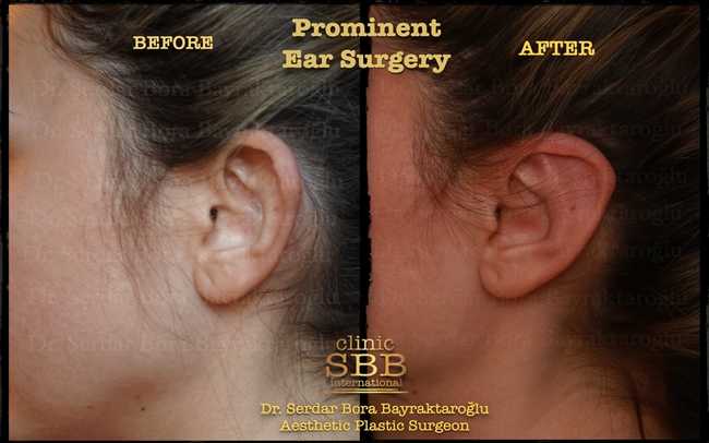 prominent ear before after 1