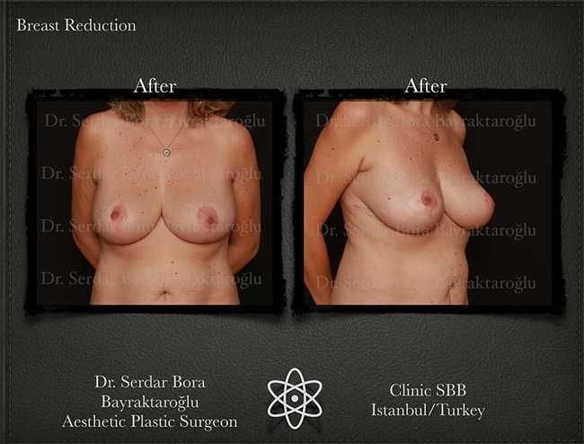Breast Reduction Before After Serdar Bora Bayraktaroglu In Istanbul Clinic 8