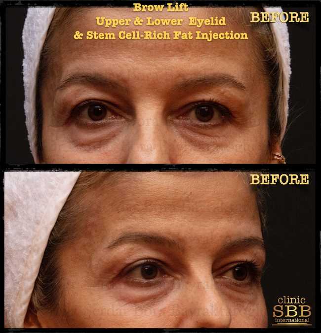 eyebrown lift before after 1