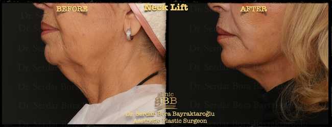 face neck lift before after 16