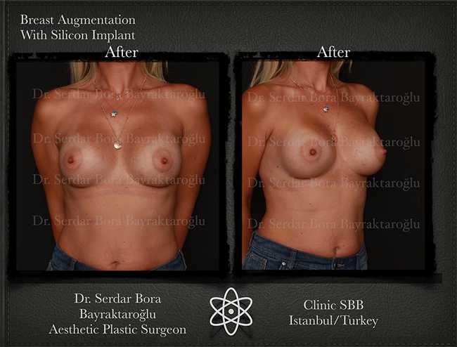 Breast Augmentation Before After Serdar Bora Bayraktaroglu In Istanbul Clinic 16 1