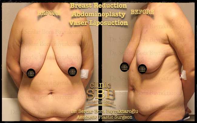 vaser liposuction before after 11