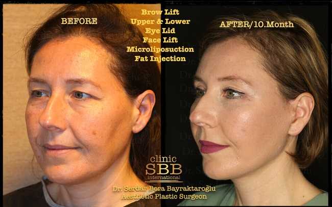 face neck lift before after 13