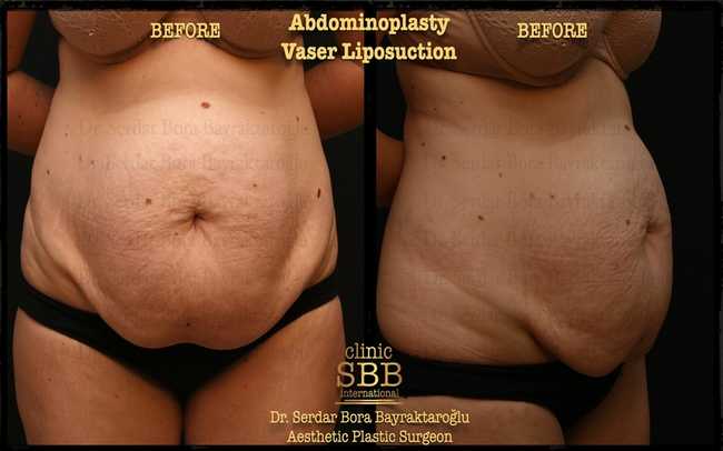 abdominoplasty before after 1