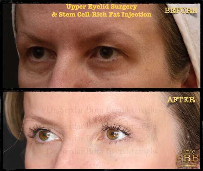 upper lower eye lid before after 3