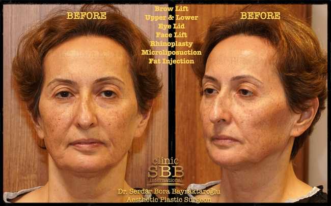 face neck lift before after 4