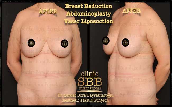 breast reduction before after 1