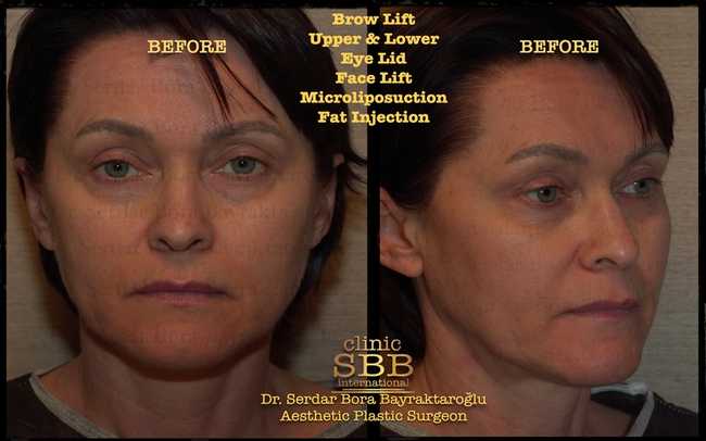face neck lift before after 6