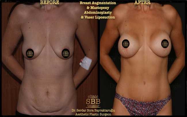 breast augmentation mastopexy before after 2