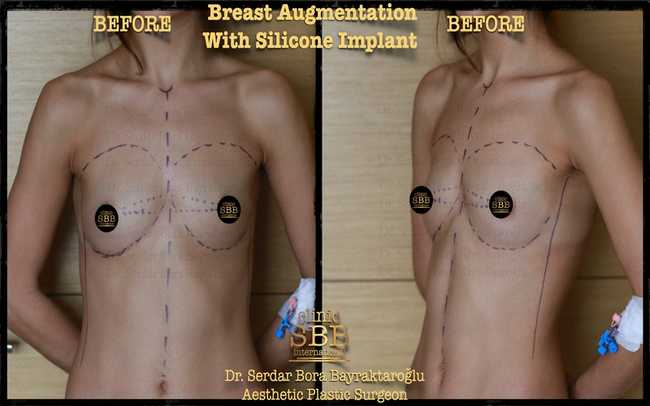 breast augmentation before after 8