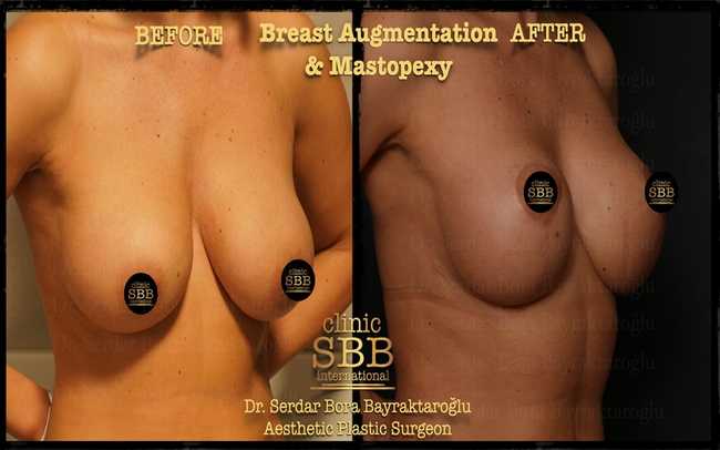 breast augmentation mastopexy before after 8