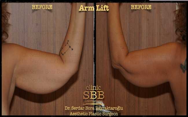 arm leg lift before after 1