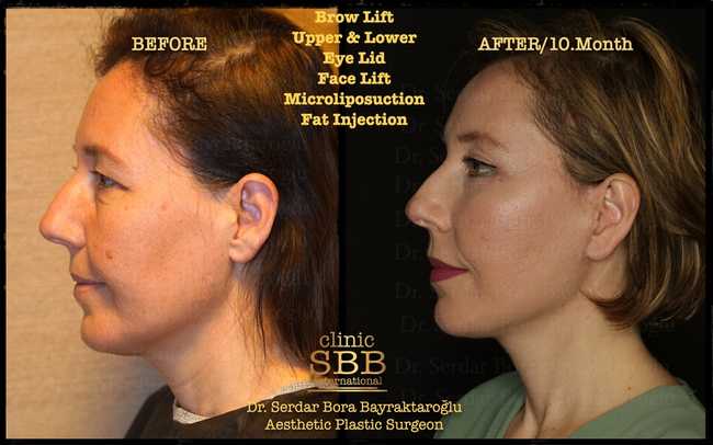 face neck lift before after 14