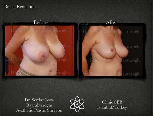Breast Reduction Before After Serdar Bora Bayraktaroglu In Istanbul Clinic 7