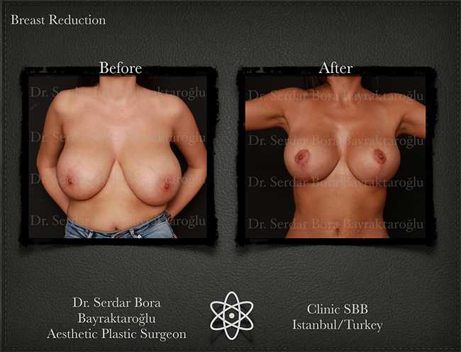 Breast Reduction Before After Serdar Bora Bayraktaroglu In Istanbul Clinic 2