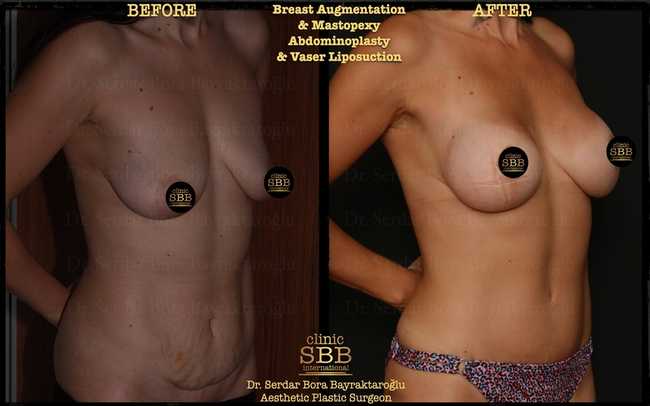 breast augmentation mastopexy before after 3