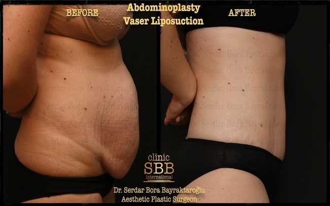 abdominoplasty before after 4