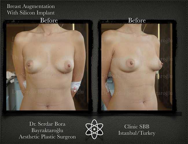 Breast Augmentation Before After Serdar Bora Bayraktaroglu In Istanbul Clinic 13 1