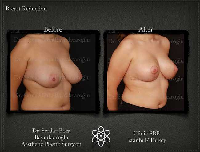 Breast Reduction Before After Serdar Bora Bayraktaroglu In Istanbul Clinic 11