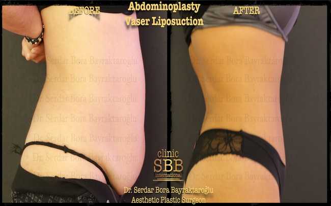 abdominoplasty before after 8