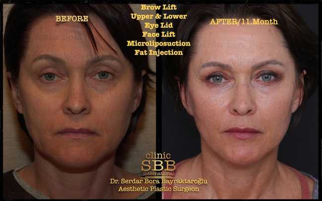 face neck lift before after 7