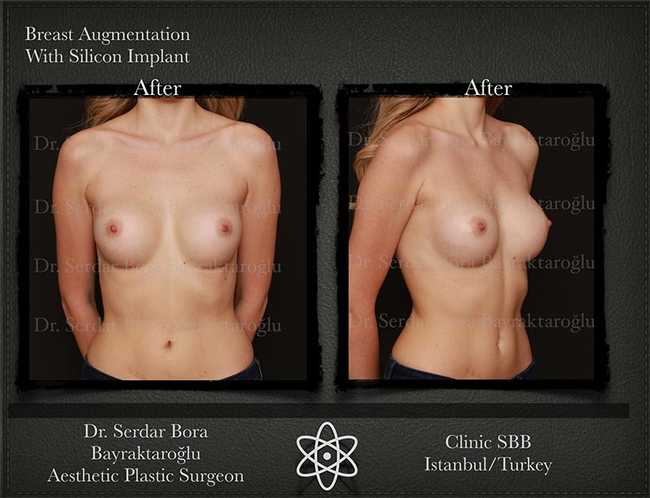 Breast Augmentation Before After Serdar Bora Bayraktaroglu In Istanbul Clinic 4 1