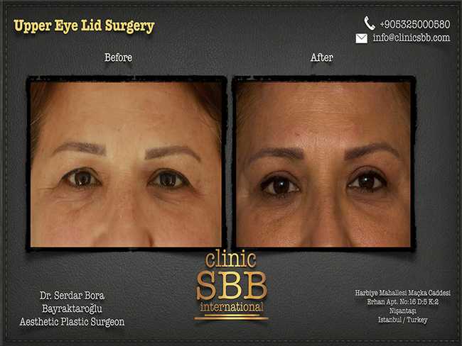 Eye Lid Surgery Clinic SBB Serdar Bora Bayraktaroglu